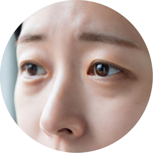 다크서클 추천 시술 1