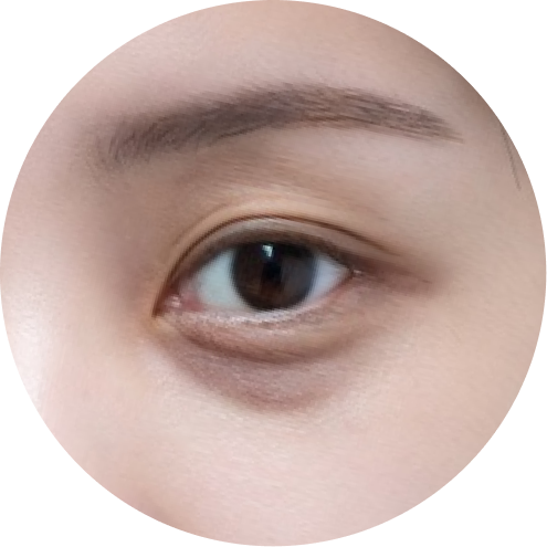 다크서클 추천 시술 2