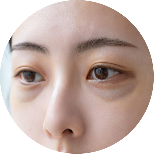 다크서클 추천 시술 4