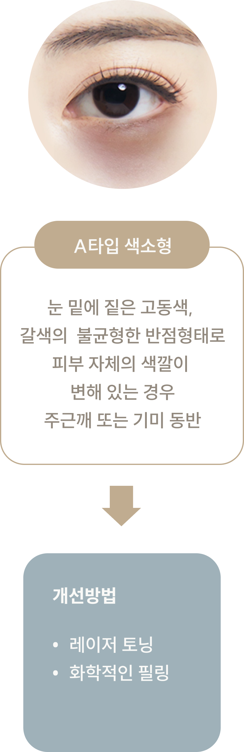 상안검