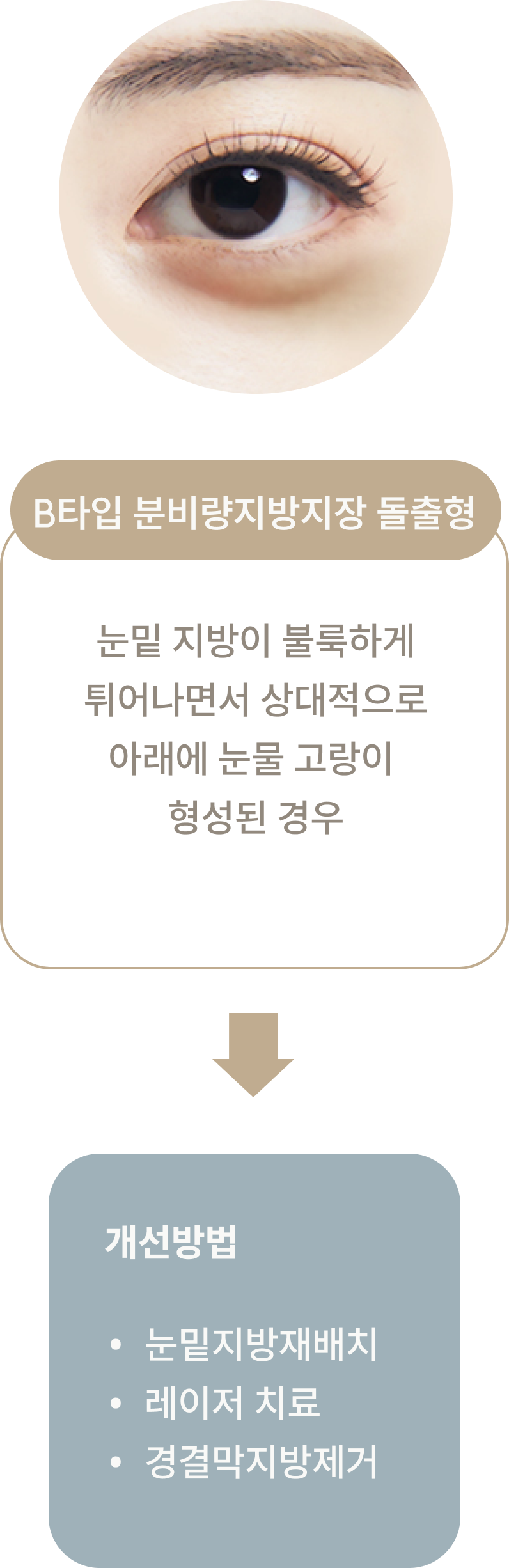 눈썹거상